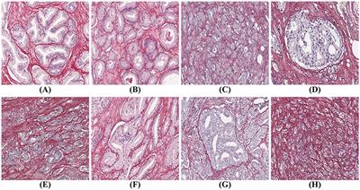 Glandular Segmentation of Prostate Cancer: An Illustration of How the Choice of Histopathological Stain Is One Key to Success for Computational Pathology